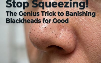 Stop Squeezing! The Genius Trick to Banishing Blackheads for Good