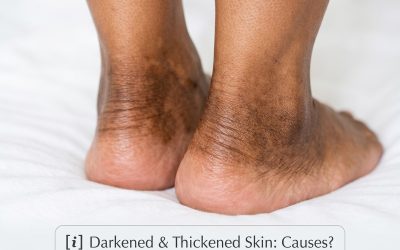 The skin around my ankles is getting darker and thicker over time. What causes this?
