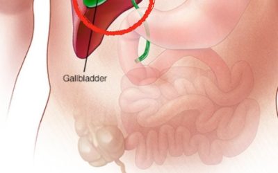 What Happens to the Body After Gallbladder Removal? 3 Diseases That May Follow – Avoid Surgery If Possible