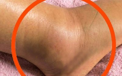 Swollen legs: what could it mean? Common causes you should never ignore.