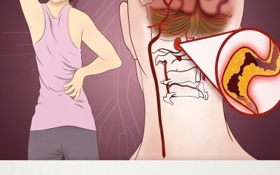 The 10 Early Warning Signs of a Stroke Everyone Misses