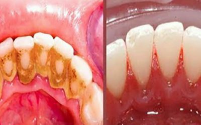 Avoiding the dentist: Here’s how you can do it using just 2 ingredients you have at home
