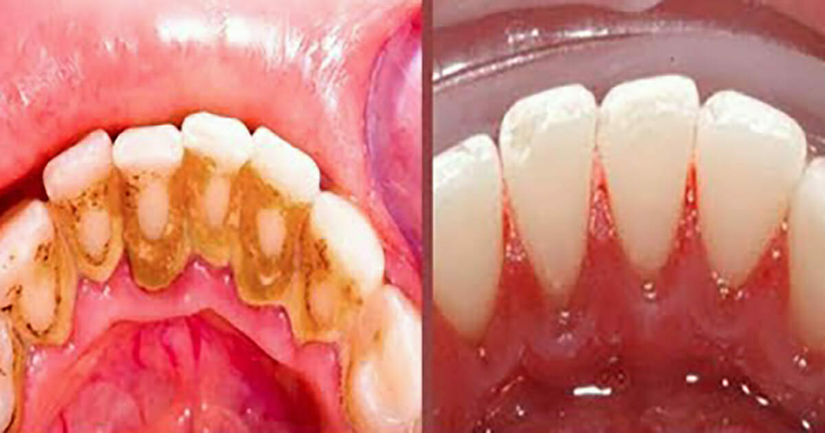 Avoiding the dentist: Here’s how you can do it using just 2 ingredients you have at home