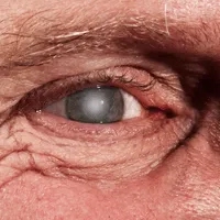 By Age 80, Half of All North Americans Will Deal with Cataracts