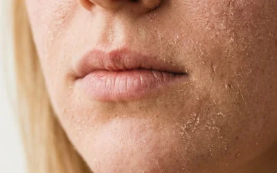 Home Remedies for Dry Skin That Actually Work
