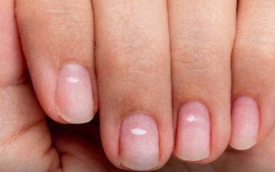 Having white spots on your nails is a sign that your body is…See more